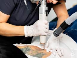 How to Become a Laser Tattoo Removal Technician